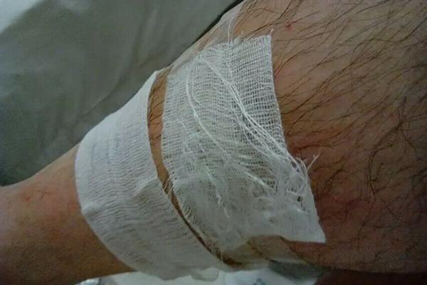 十大促进伤口愈合的食物，刀口有个洞一直不愈合（伤口消毒应该用什么）