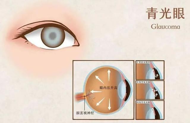 内衣跑杯的原因，内衣穿着穿着就跑杯了的原因有哪些（伤颈变丑还越睡越累）