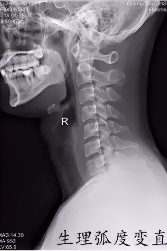 颈椎侧弯怎么矫正，颈椎病生理弯曲消失了怎么办