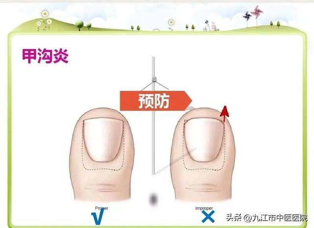 甲沟炎不到10元搞定，甲沟炎长肉芽怎么办?不用拔甲（九江市中医医院帮您搞定）