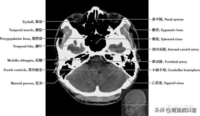 智力扣全套解法图解，智力扣九连环解法（详细标注版——颅脑CT正常解剖图谱）