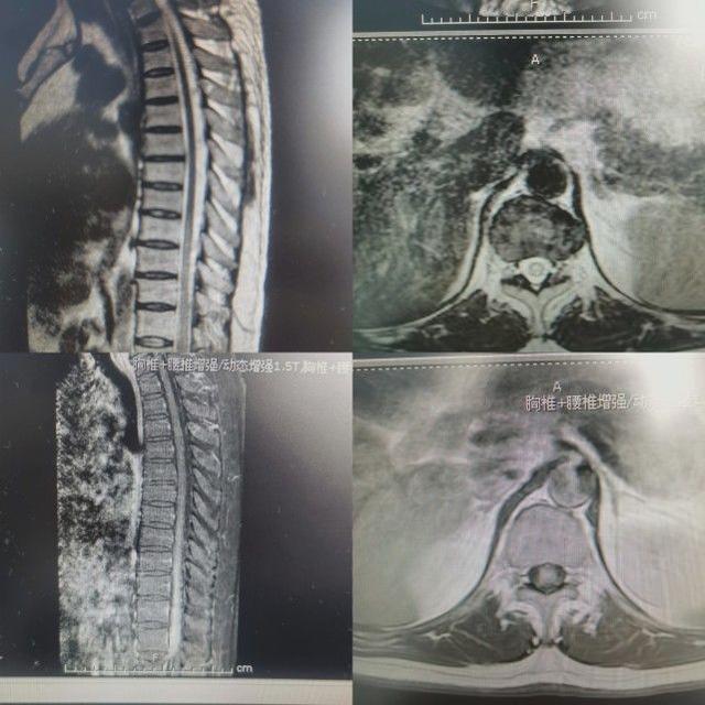 关于脊髓疾病介绍，脊柱脊髓疾病的诊断和治疗（下肢麻木无力未重视）