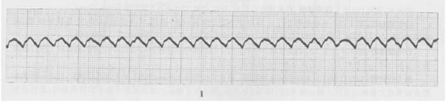 什么是大炮音，大炮音是怎样产生的（心律失常<五>）