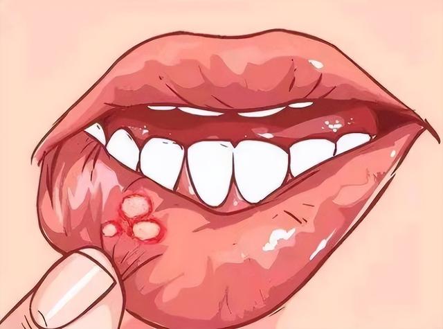 嘴巴经常长口腔溃疡什么原因，嘴巴经常溃疡是什么原因（口腔溃疡反复发作）