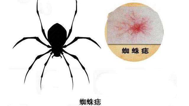 中间是深红色的斑块,周边放射出像蜘蛛腿一样的血管线条,这样的线条有