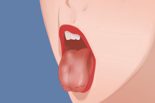 舌头肥大有齿痕是怎么回事，齿痕舌怎么调理才能好（舌头边缘有齿痕）
