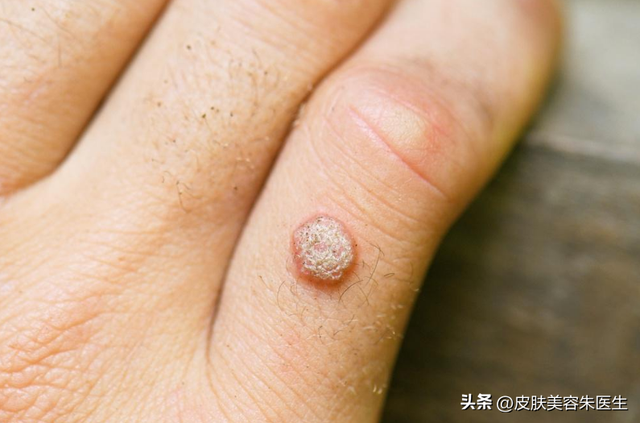 疣的分类与治疗，还有这几种疣也很常见