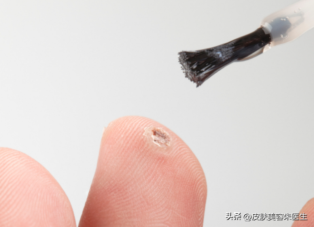 疣的分类与治疗，还有这几种疣也很常见