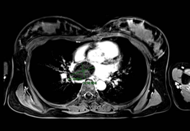 心脏癌最严重的肿瘤，得上心血管肉瘤，比癌症还可怕