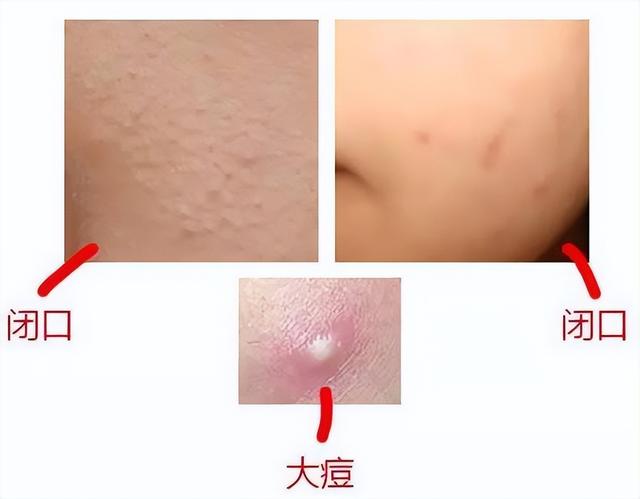 脸上闭口粉刺多怎么办，满脸都是闭口粉刺怎么办（今蝉护肤：闭口粉刺怎么去除）