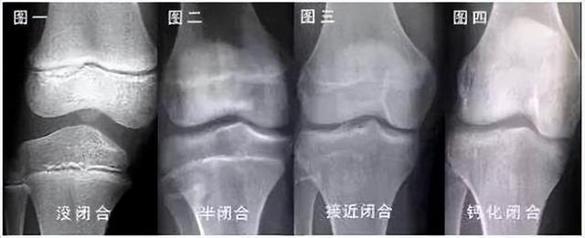 增高针长什么样，增高针、性抑制针......焦虑孩子身高