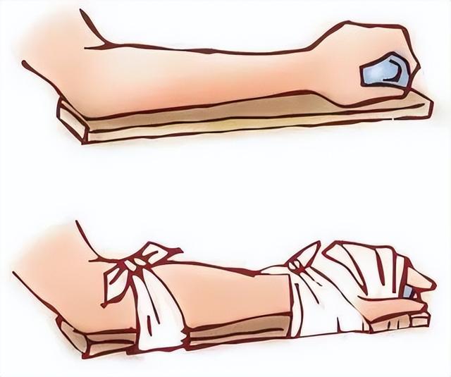 摔伤后怎么处理，如果摔伤了应该怎么办（建议收藏丨学会这些常见损伤的应急处理）