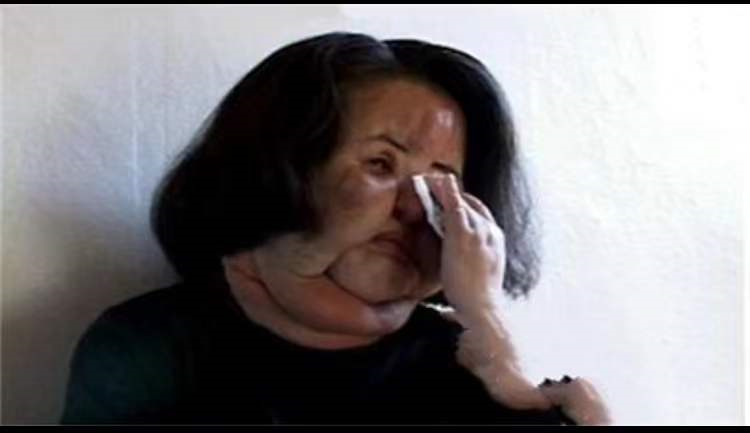 磨颧骨毁容的案例（韩慧景自行注射食用油）