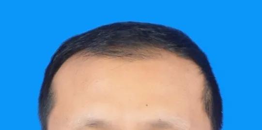 眉毛种植疼吗，种植眉毛有用吗（16000字讲述植发真实感受）