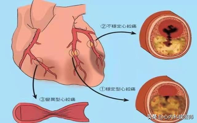 心脏供血不足吃什么药好(心肌缺血吃什么药最好) - 百百科