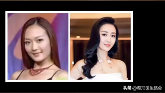 鼻翼肥大怎么办，鼻翼肥大怎么改善（如何改善鼻头圆和鼻翼宽）
