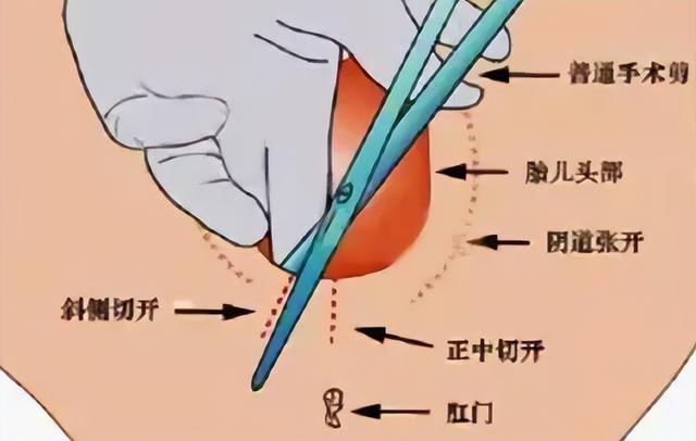 滞留针是什么 滞留针的解释，滞留针是什么（32年后当事人：赔我100万）