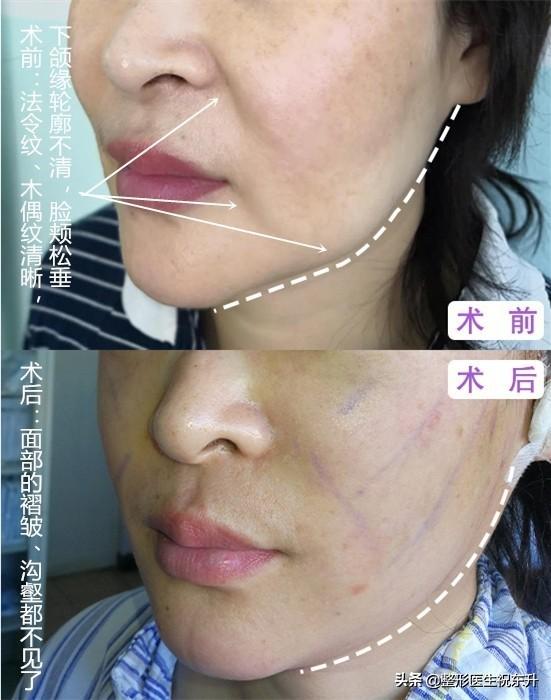 怎样淡化法令纹，怎么淡化法令纹（这“3个方法”实用又有效）