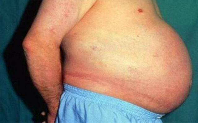 人的大肠有多少米，人的肠子有多长（约翰因3年不排大便去世）