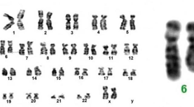 6号微小染色体缺失，英国女孩变成“三无人类”