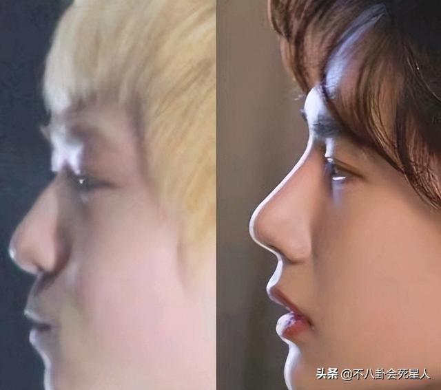 整容后遗症有哪些，整容后遗症有哪一些（明星整容后遗症明显）