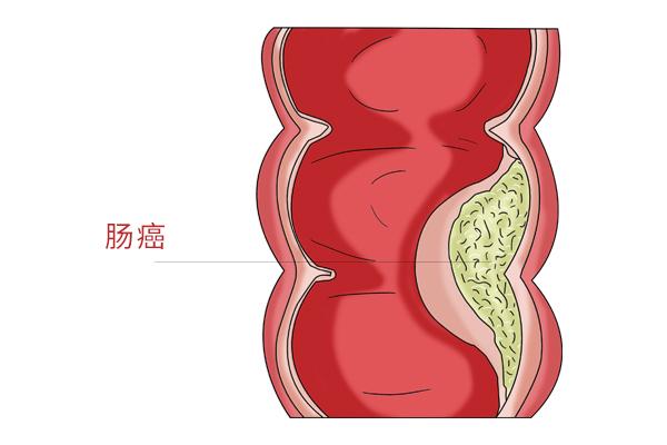 拉大便拉不出来怎么办最快方法，拉屎拉不出来怎么办（总觉得大便排不干净）