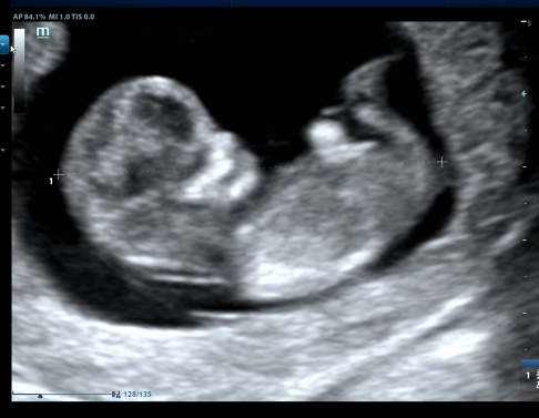 刚怀孕如何判断是男是女，刚怀孕如何判断是儿是女（彩超单子能看性别吗）