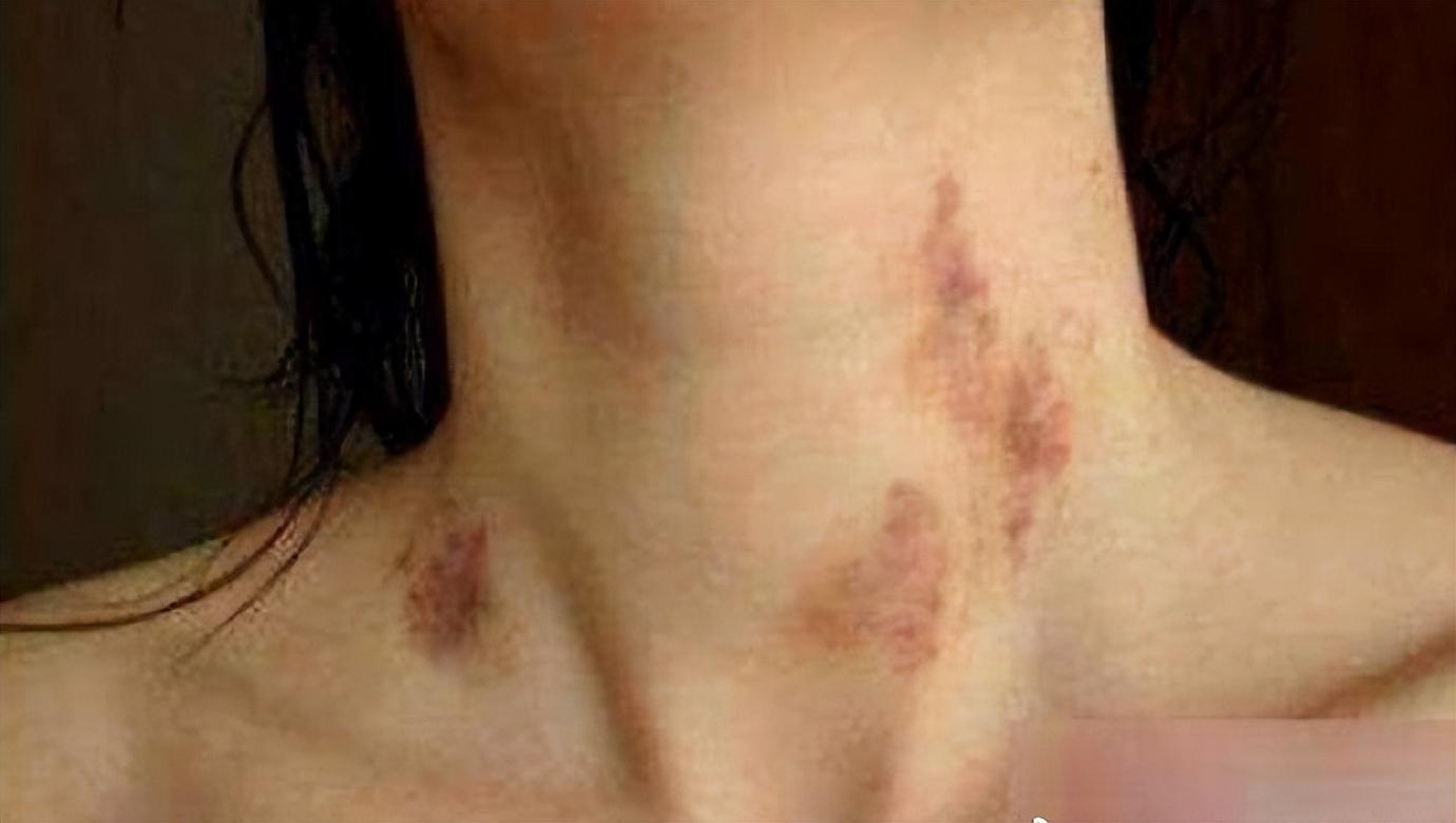 脖子上的吻痕图片,脖子上有吻痕