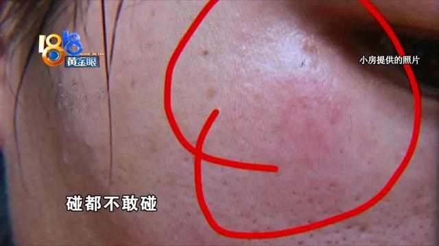 果酸换肤祛痘效果怎么样，果酸换肤祛痘效果怎么样的（“果酸焕肤”又红又肿）