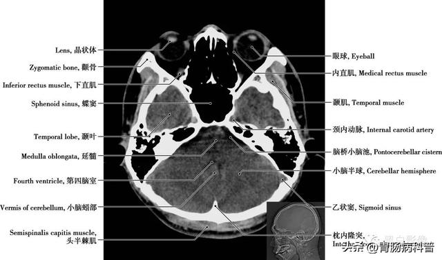 智力扣全套解法图解，智力扣九连环解法（详细标注版——颅脑CT正常解剖图谱）