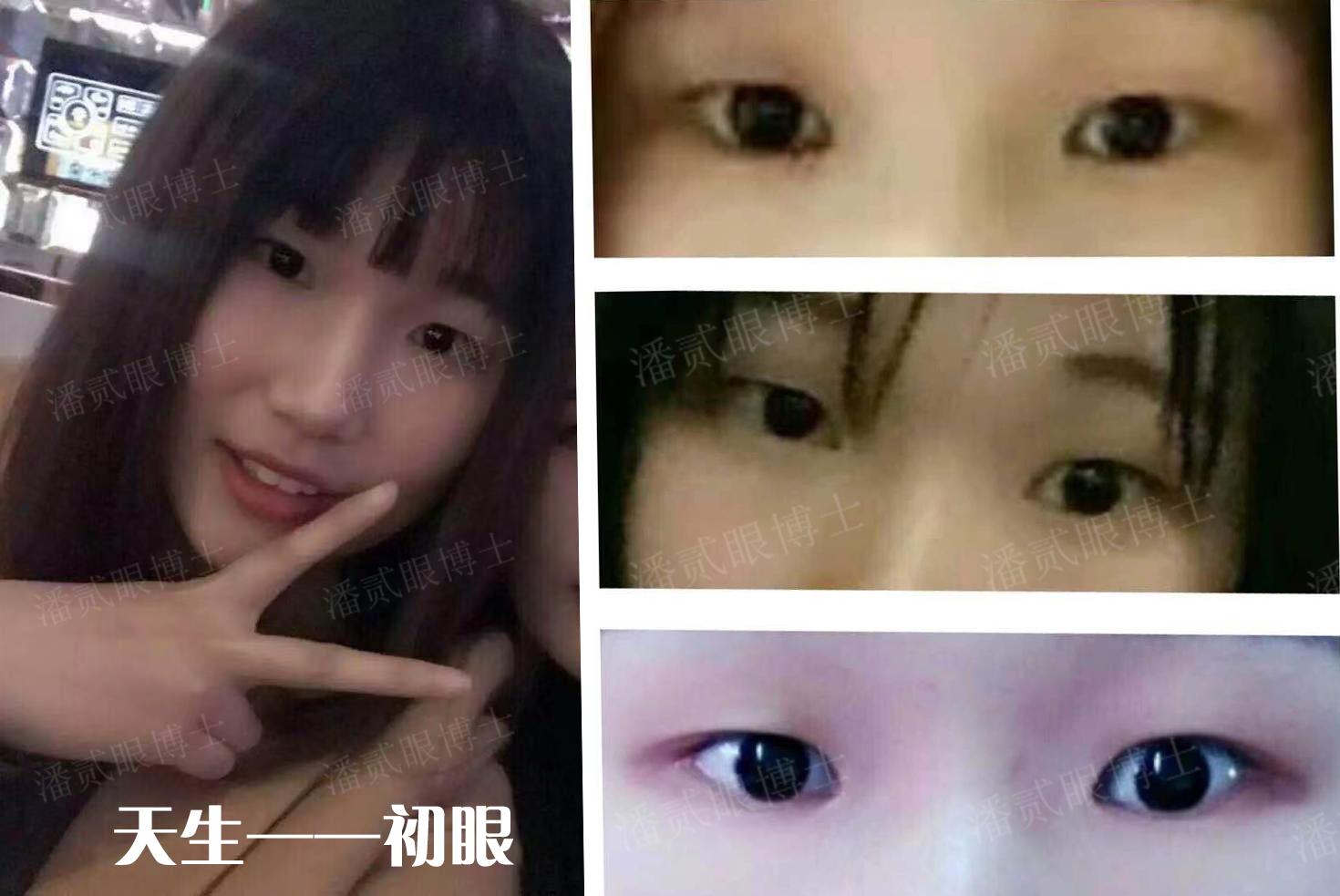 做了双眼皮眼睛凹案例（广州美女整形失败）