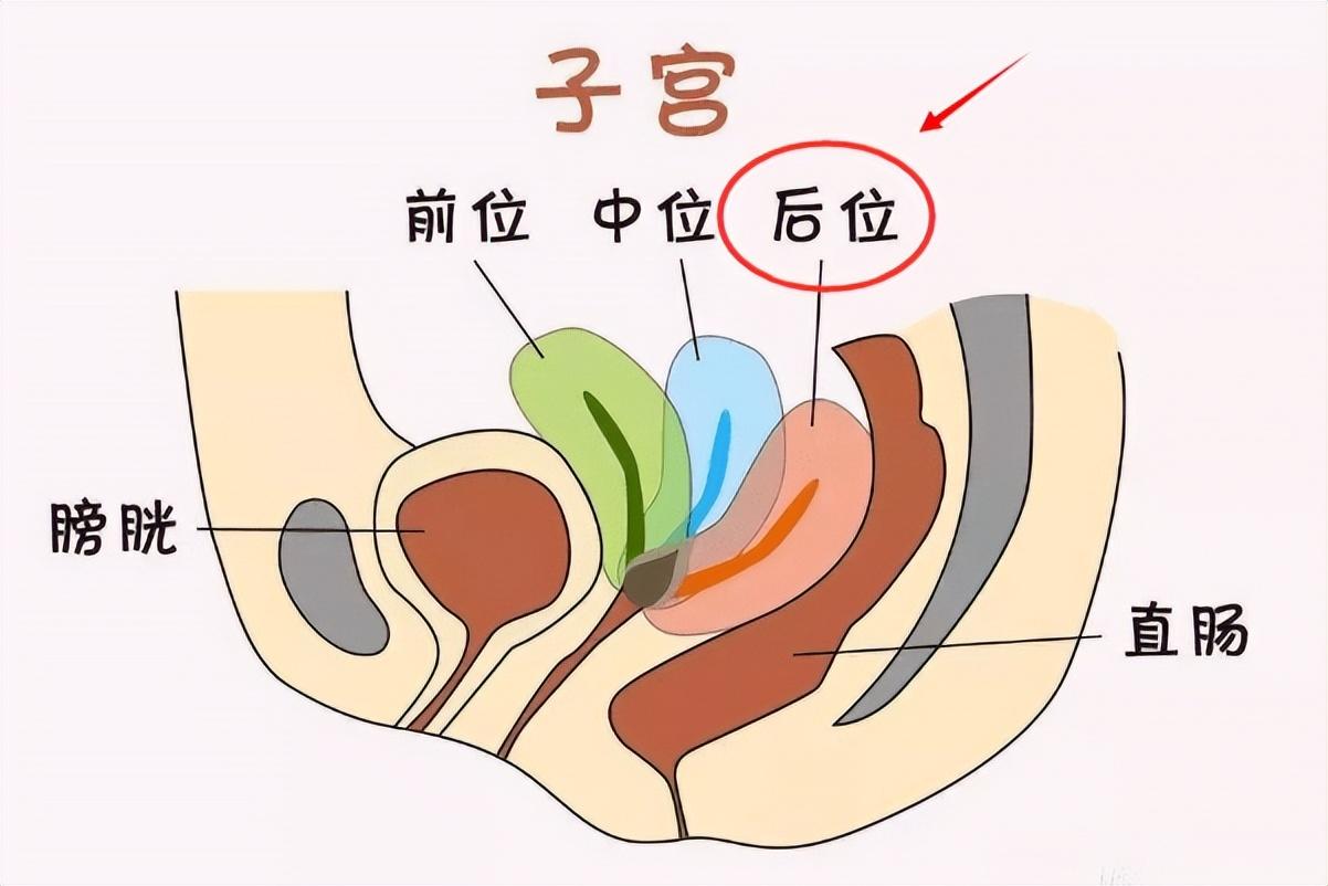 为什么说子宫后位难怀孕?