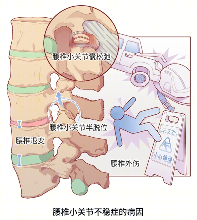 突然闪到腰了应该怎么办，一不小心闪到腰了怎么办（好好的腰，怎么说闪就闪）