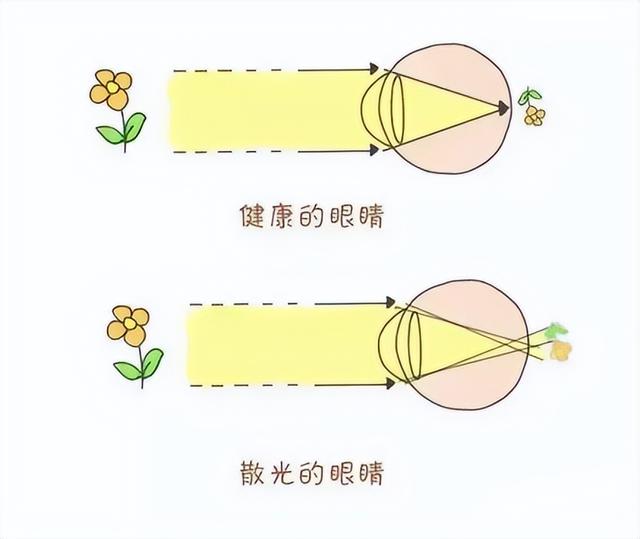 宝宝眼睛散光怎么办呢，宝宝眼睛散光（麦迪格眼科：孩子散光了怎么办）