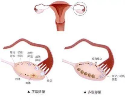 什么是多囊卵巢综合症，什么是多囊卵巢综合症怎么回事（科普 ， 认识多囊卵巢综合征）