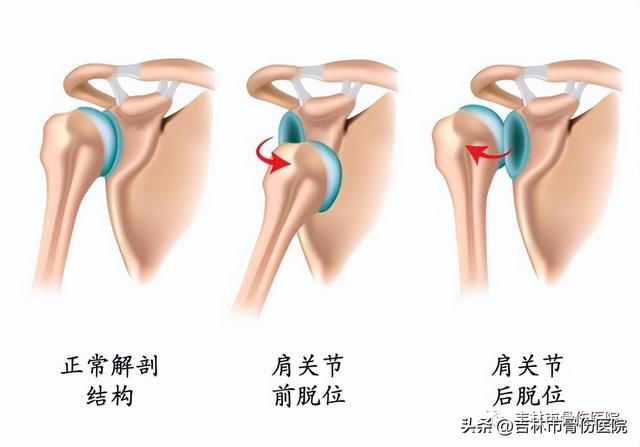 肩关节脱位手法复位，肩关节脱位最常用复位方法步骤（肩关节脱位症状与手法复位）