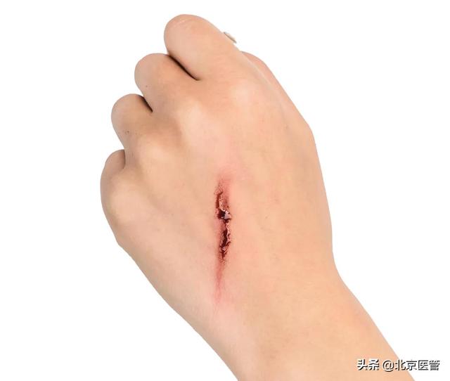 一针破伤风多少钱,打破伤风的佳时间(哪些伤口易引起破伤风) 一针破伤风多少钱,打破伤风的佳时间(哪些伤口易引起破伤风)