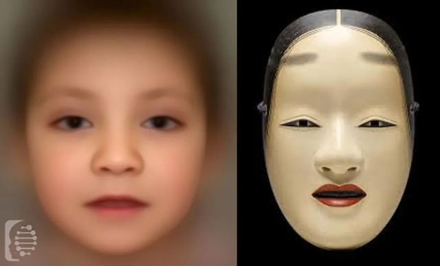 蓝妮妮是歌舞伎面谱综合征，歌舞伎综合症宝宝照片（大眼睛、尖下巴、精灵耳…长得太美也是一种病）