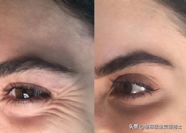 面部提升除皱的原理，面部除皱效果（面部除皱这3种方法还不错）