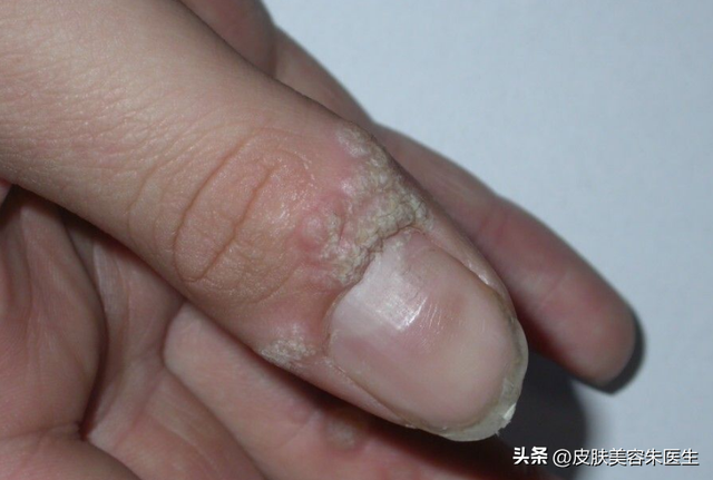 疣的分类与治疗，还有这几种疣也很常见