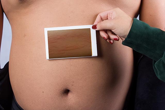 急性荨麻疹会自愈吗，急性荨麻疹止痒小妙招（医生：急性发作可能要命）