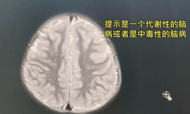 酒精擦拭退烧的正确方法，致4岁女儿住进ICU