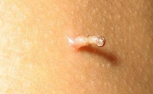 手上长一粒粒凸起图片白色，手臂上有米粒白色凸起图片（扁平疣和寻常疣、丝状疣的区别）