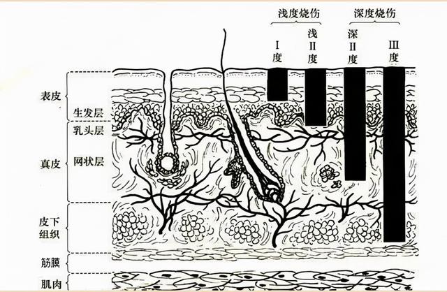 深2度烫伤愈合后6个月疤痕图片，深二度烫伤疤痕图片（烧烫伤疤痕的两个最佳治疗时期）