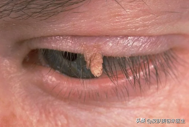 疣的分类与治疗，还有这几种疣也很常见