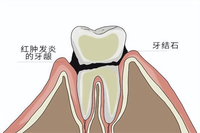 牙缝臭是什么原因，口腔残留物很臭什么原因（为什么牙缝里会有臭臭的“黄泥”）