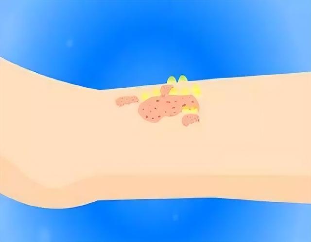 玫瑰糠疹吃什么药，玫瑰糠疹吃什么药好使（“万能皮肤药”炉甘石洗剂）