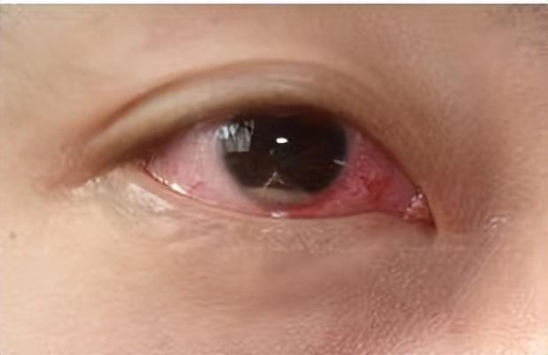 眼睛炎症的症状 这7种眼病很常见,要如何治疗?