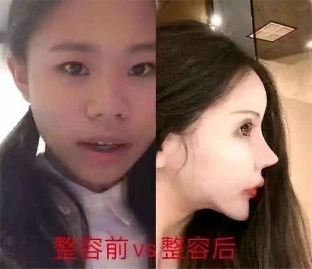 隆胸手术的真正人体过程，女主播大胆直播丰胸手术全过程