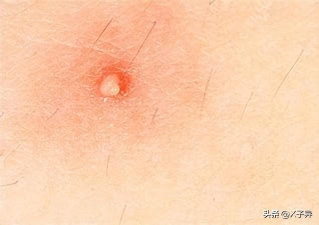 上火长痘痘怎么办，天热上火长痘怎么办（脸上长痘咋办，正确着手才能好）